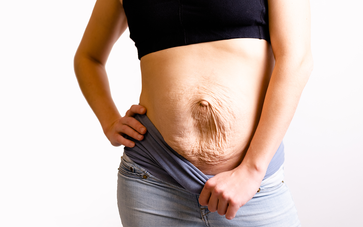 What is Diastasis Recti?